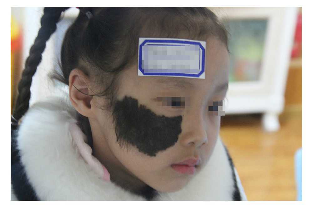 黑毛痣.jpg